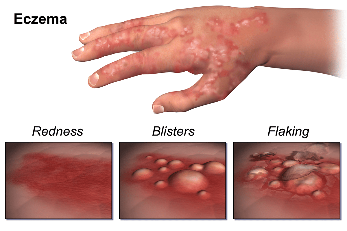 The Differences Between Rashes and Eczema (And How to Tell Which One You  Have)