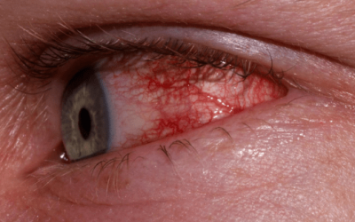 What Is Allergic Conjunctivitis?