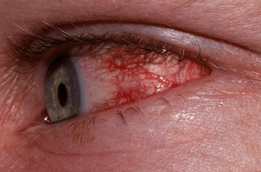 What Is Allergic Conjunctivitis?